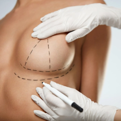 Cost Of Breast Augmentation in Dubai