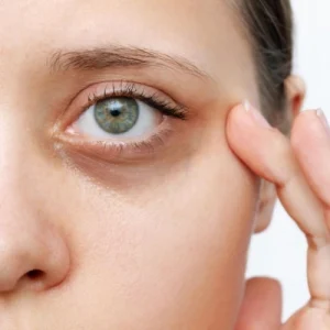 How To Remove Dark Circles Under Eyes Permanently