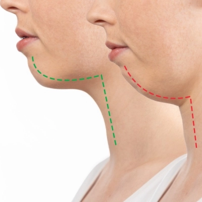 Orthognathic Surgery Dubai