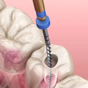7 Signs You Need a Root Canal and What to Expect Next
