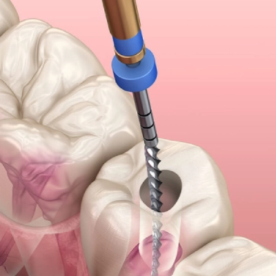 7 Signs You Need a Root Canal and What to Expect Next
