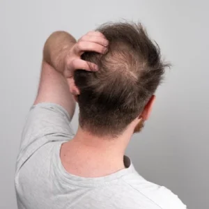Does Mounjaro Cause Hair Loss