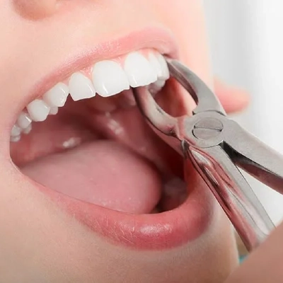 Tooth Extraction Dubai