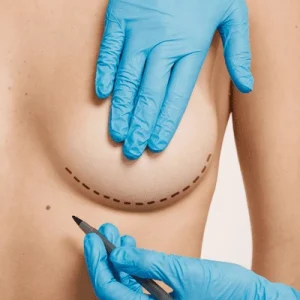 What Is a Minimal Scar Breast Lift