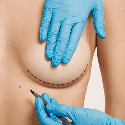 What Is a Minimal Scar Breast Lift