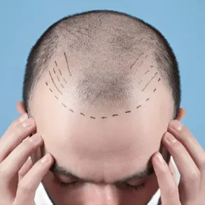 7 Signs You’re a Good Candidate for a Hair Transplant