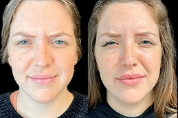 Baby Botox Dubai Before and After Baby Botox Dubai Before and After
