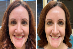 Before and After Baby Botox