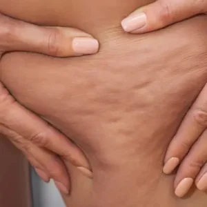 How to Get Rid of Cellulite on Your Legs and Bum