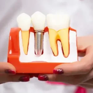 Dental Implant Healing Timeline After Surgery