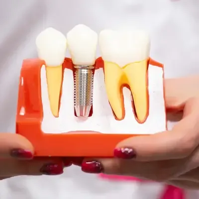 Dental Implant Healing Timeline After Surgery