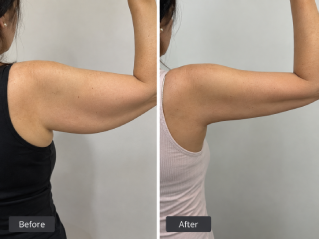 Arm Lift Surgery in Dubai Before and After
