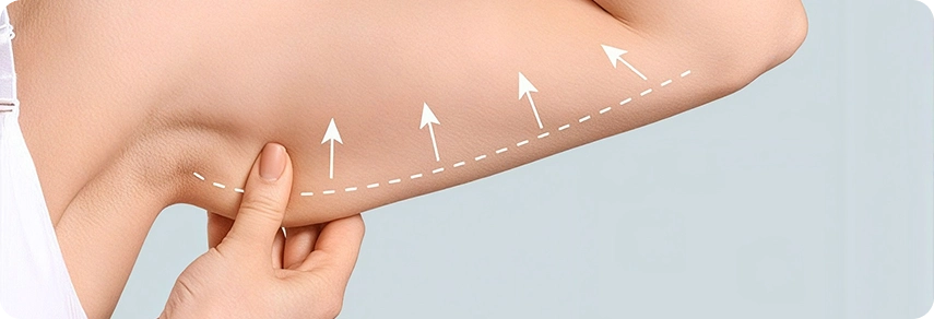 Arm Lift Surgery