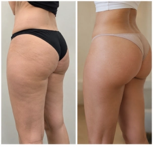BBL Before and After