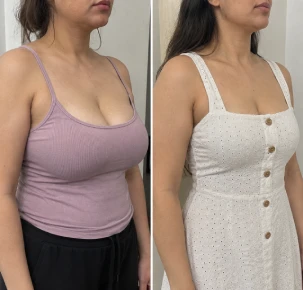 Before And After Breast Reduction Surgery