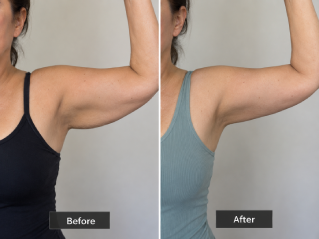 Before and After Arm Lift (Brachioplasty) Surgery in Dubai pic