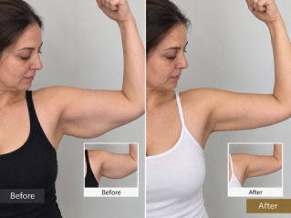 Before and After Brachioplasty in Dubai