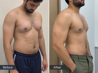 Before and After Gynecomastia Surgery in Dubai