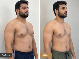 Before and After Male Breast Reduction (Gynecomastia Surgery) in Dubai