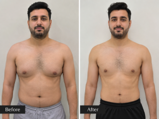 Before and After Male Breast Reduction in Dubai