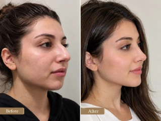 Before and After Rhinoplasty