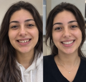 Before and After Teeth Whitening in Dubai