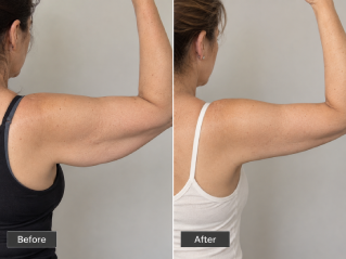 Brachioplasty in Dubai Before and After