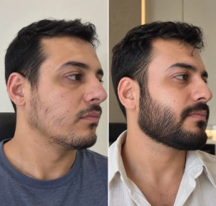 Bread Transplant in Dubai Before and After