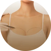 Breast Lift Surgery (Mastopexy)