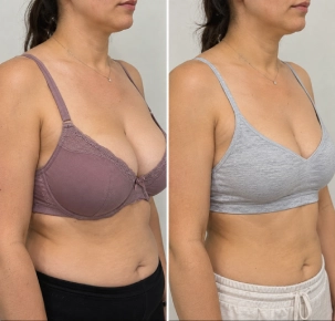Breast Reduction Surgery Before And After