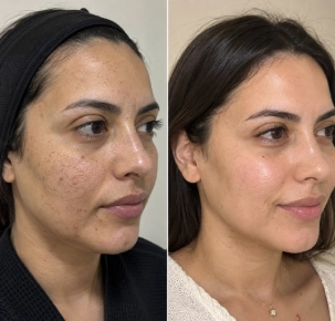 Carbon Laser Peel in Dubai Before and After