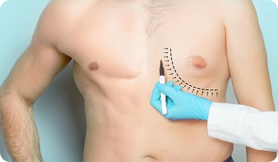 Combination Liposuction and Gland Excision