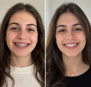 Dental Braces in Dubai Before and After