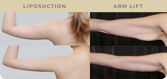 Difference between Arm lift Surgery and Liposuction
