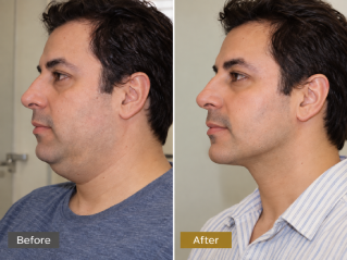 Double Chin Lipo Before and After Results