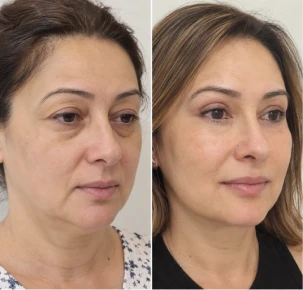 Double Chin Removal in Dubai Before and After