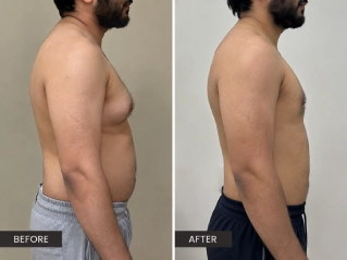 Gynecomastia Surgery Before and After