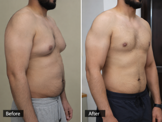 Gynecomastia Surgery in Dubai Before and After