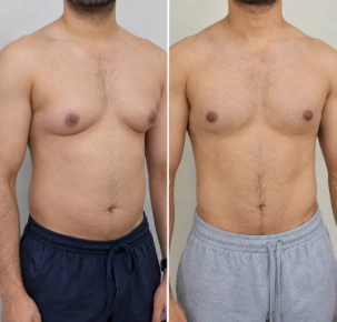 Gynecomastia Surgery in Dubai Before and After