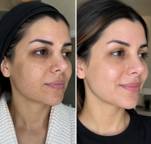 Hydrafacial Treatment in Dubai Before and After