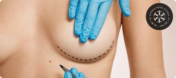Implant placement for Breast Enlargement