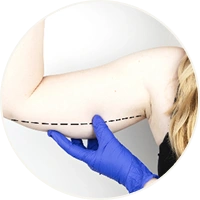 Incision Closure Arm Lift Surgery