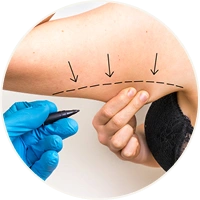 Incision Planning for Arm Lift Surgery