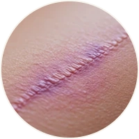 Incisions for Arm Lift Surgery