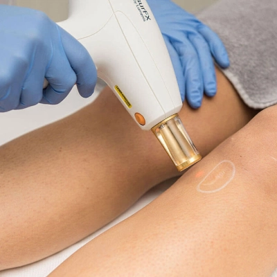 Laser Scar Removal In Dubai