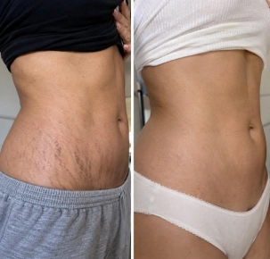 Laser Stretch Makrs Removal in Dubai Before and After