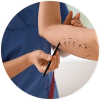 Liposuction (If required) for Arm Lift Surgery