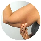 Liposuction assisted Arm Lift