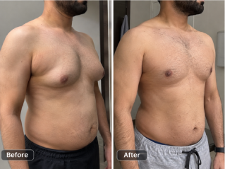 Male Breast Reduction (Gynecomastia Surgery) in Dubai Before and After