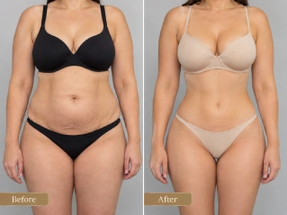 Mommy Makeover Before and After Comparison